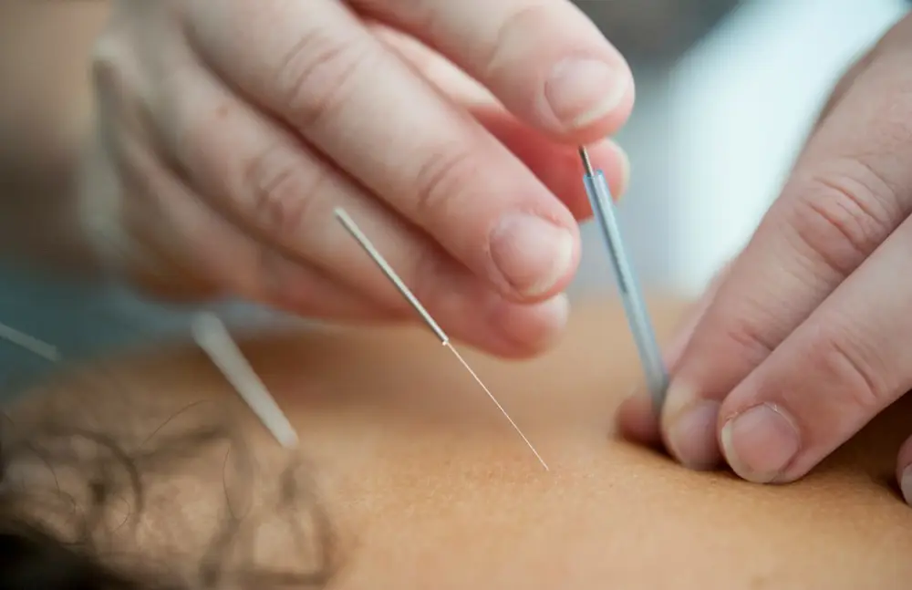 Acupuncture needles inserted into skin, illustrating acupuncture for pain relief